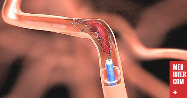 Тромбоэмболия ветвей легочной артерии